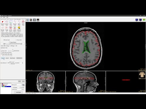 Analyze 14.0 - Segment: Auto Trace