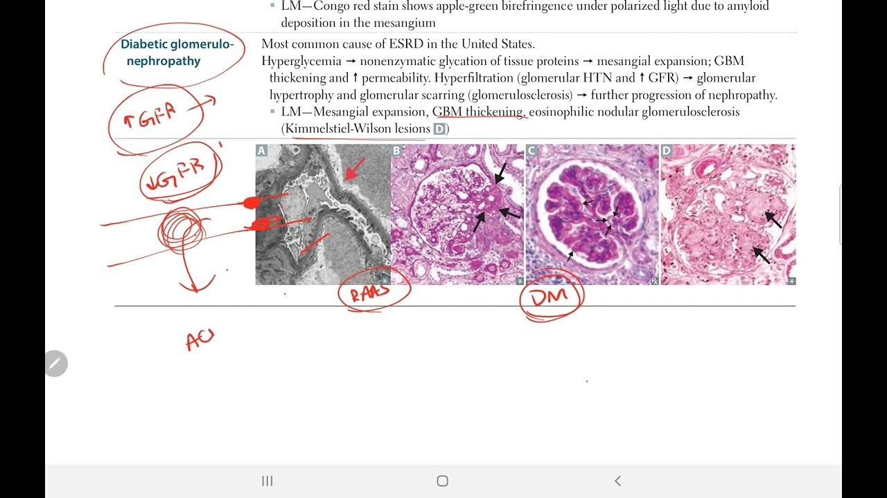 Diabetic Nephropathy Back Bencher's Academy First Aid USMLE Step 1