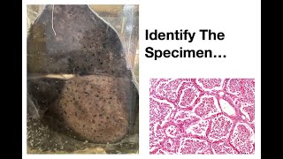 Pathology Specimen: Pneumonia Pathology Specimen: Pneumonia