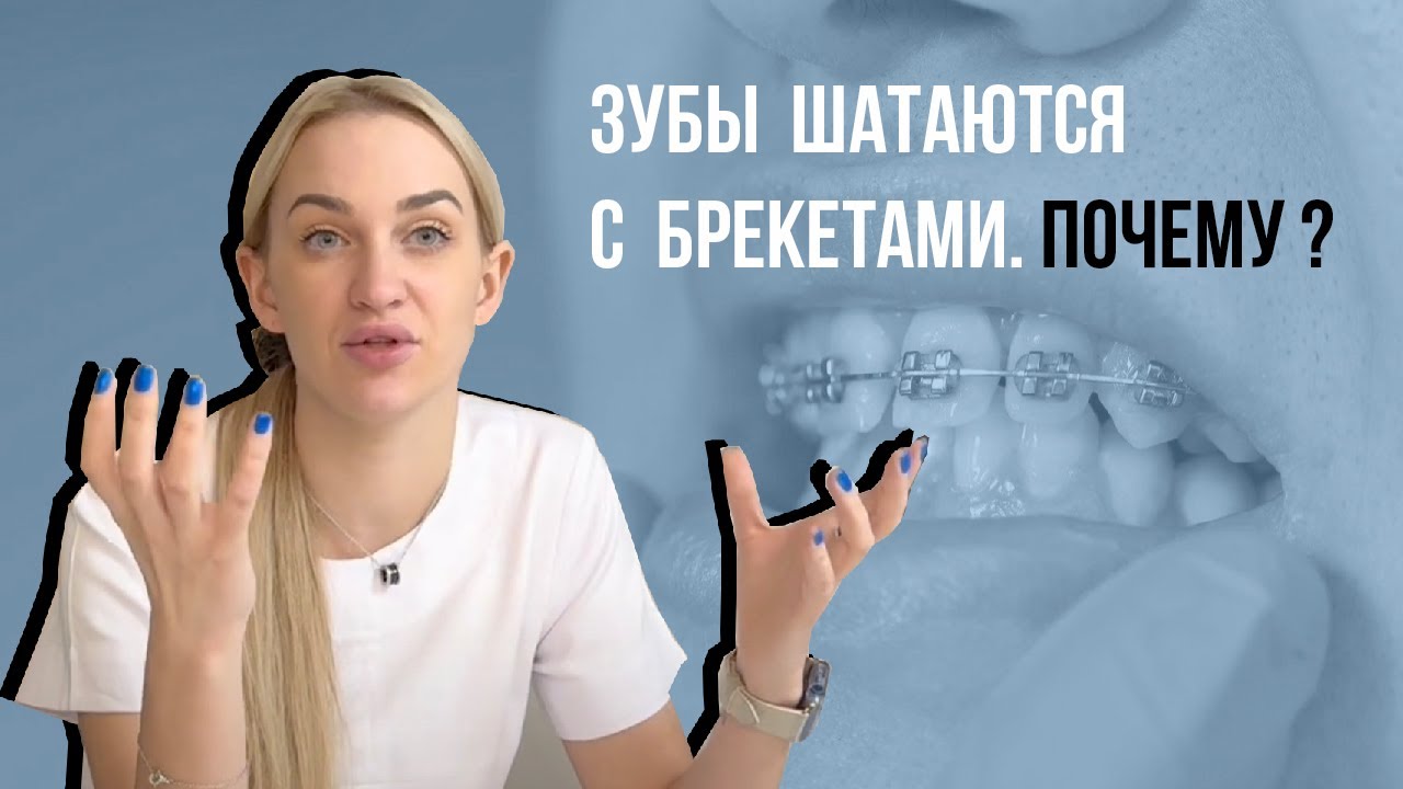 Брекеты расшатывают зубы❓Вдруг выпадут🤔