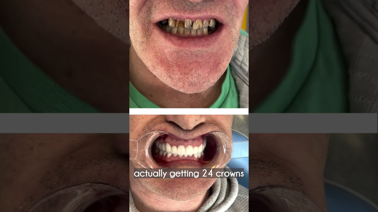 Ready for the wedding 🧿 Cosmetic Smile Design in Turkey