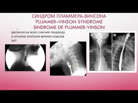 Синдром Пламмера-Винсона. Plummer–Vinson syndrome. Sindrome de Plummer-Vinson