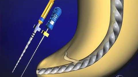 Shape Clean Pack: Canal Preparation - Finishing Criteria: Advanced Endodontics