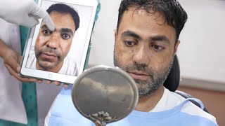 Revision Rhinoplasty | Nose Job Splint Removal & Experience in India