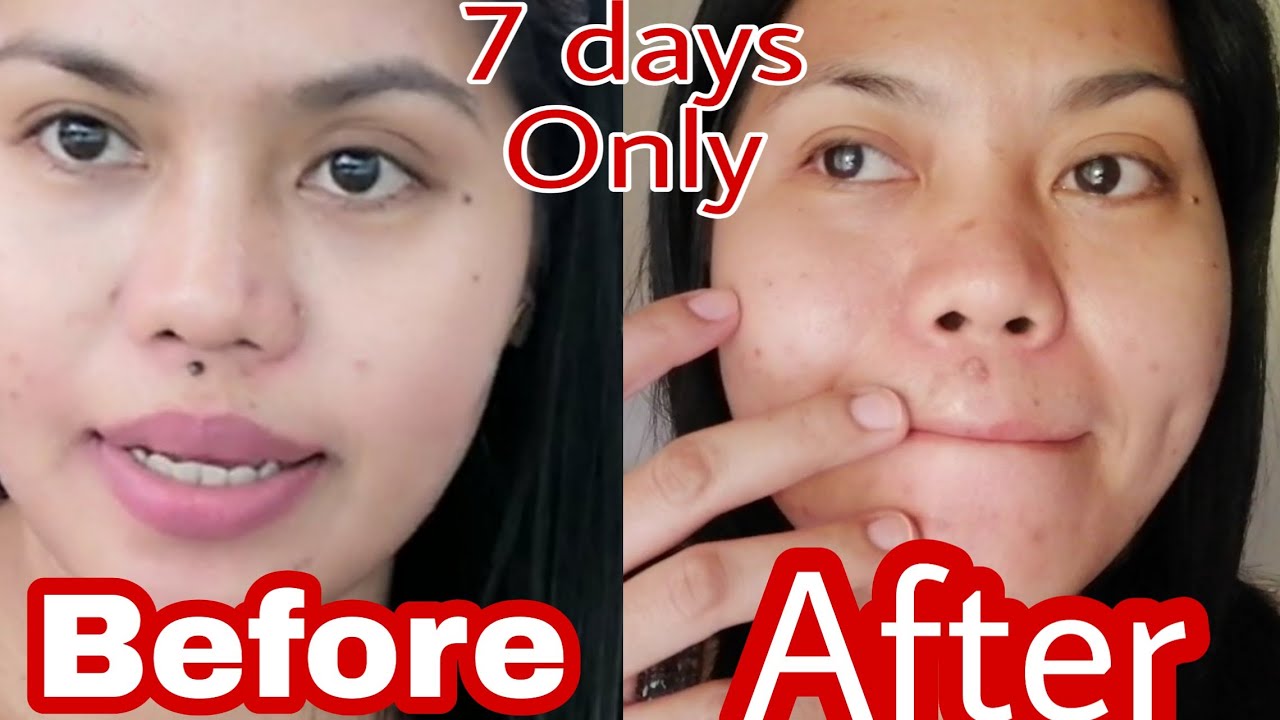 How I got Rid of my MOLE for 7 days Only, very effective Philippines (English)-Helmz Jordan