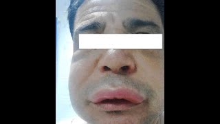 Bradykinin Basics High Yield Usmle & For Boards Angioedema Immunology, Pharmacology