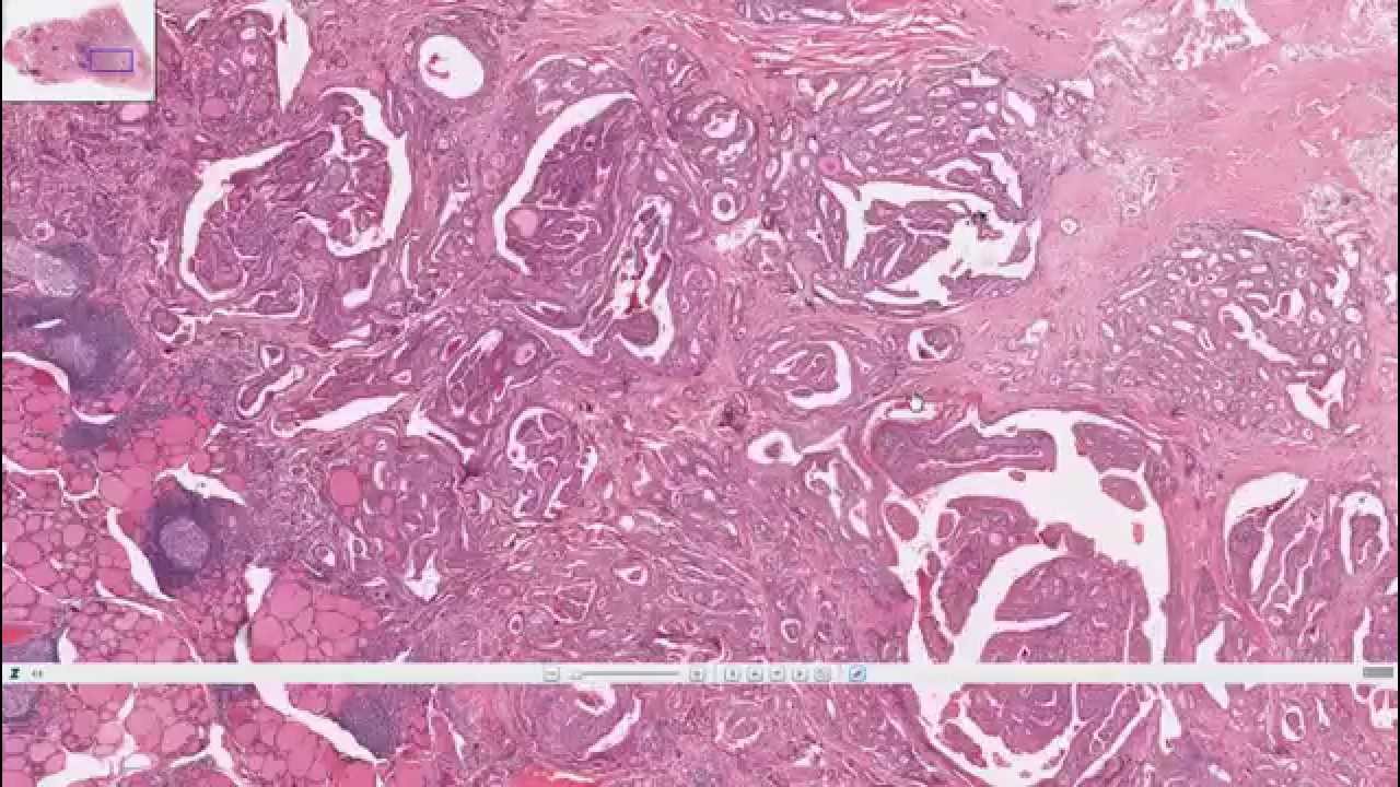 Histopatoloji - Tiroid Pappiler Ca & Foliküler Adenoma