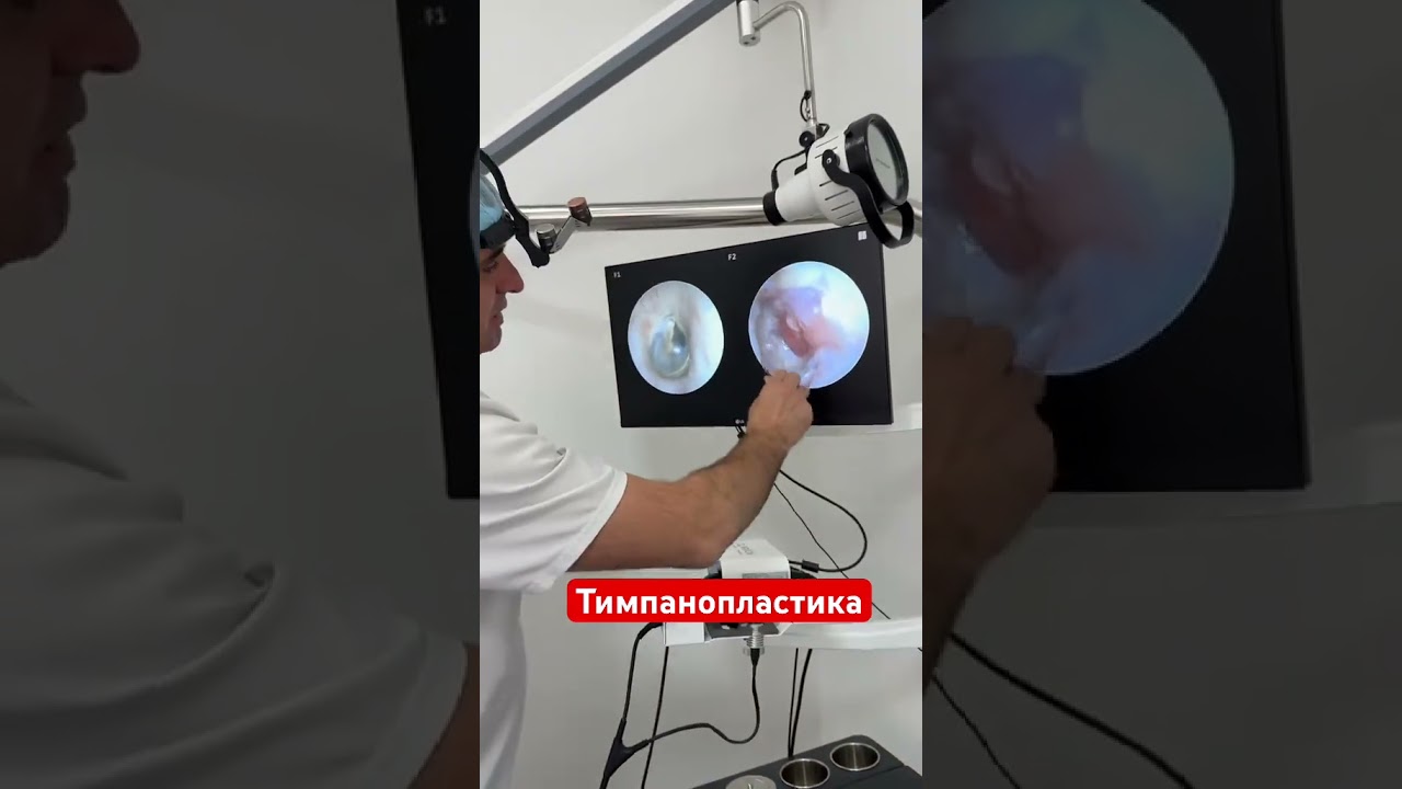 Тимпанопластика