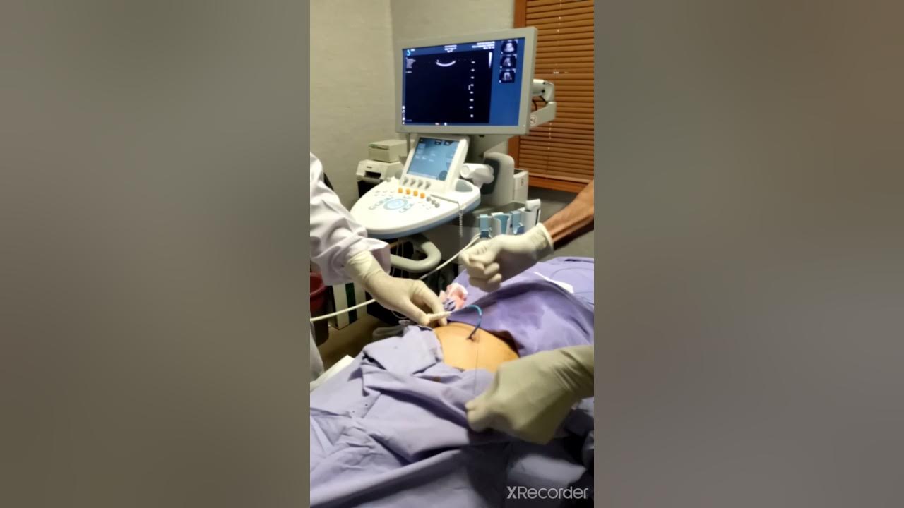 Emergency Ultrasound guided Percutaneous Nephrostomy tube placement via