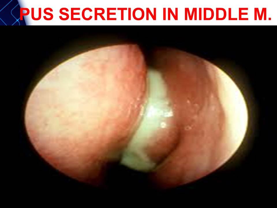 Acute Maxillary Sinusitis Dr Foheid Alsobei Youtube