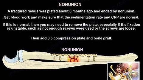 Radius & Ulnar Shaft Open Reduction Internal Fix  - Everything You Need To Know - Dr. Nabil Ebraheim