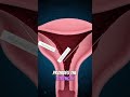 Tuberculous Endometritis Explained | Genital Tuberculosis in the Uterus #disease #warning