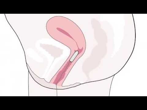 Wideo: 3 sposoby na włożenie tamponu bez bólu
