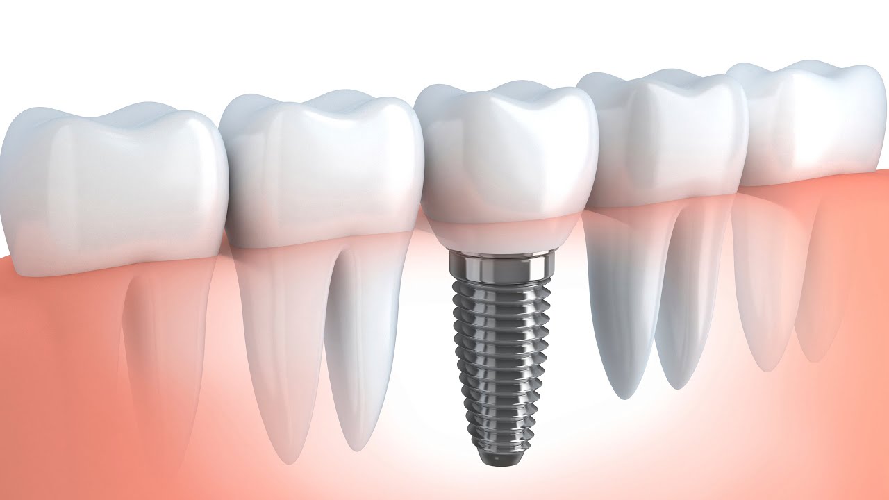 Dental Implants; Houston, Texas YouTube