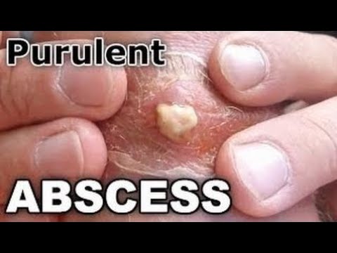 Purulent Abscess On Neck - All Pimples Channel - HD