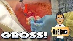 Gross Cellulitis!  MRSA, Cysts, Pimples, Surgery and Infection 