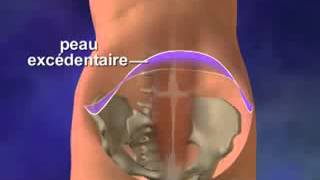 Plastie Abdominale Diminuer Lexcès De Peau Et De Graisse Au Ventre