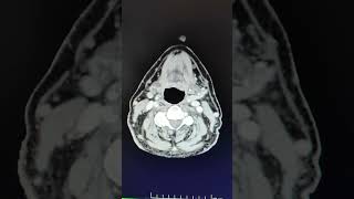 Cect Neck-- Lingual Abscess Radiology Short Cases