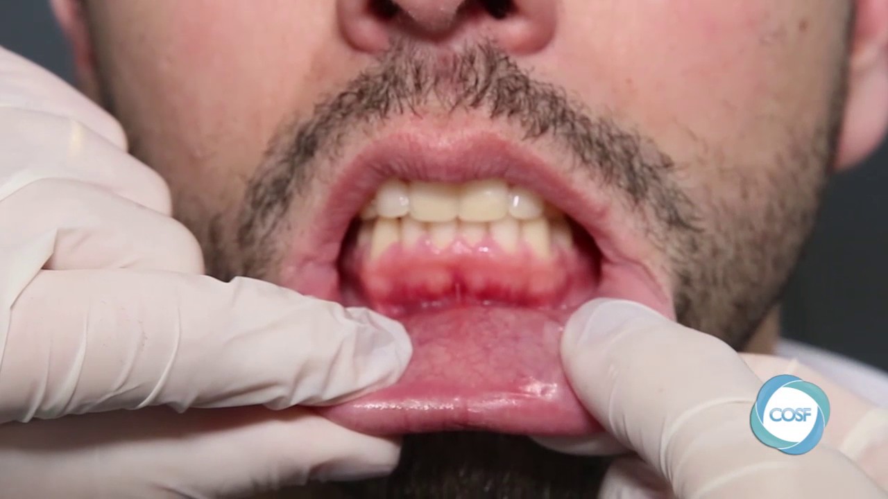 Para profesionales. EXAMEN DE TEJIDOS BLANDOS.