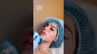 Real Patient. Real Filler. Real Results. No Filter Needed