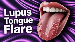 What Your Tongue Bumps Are Trying to Tell You About Lupus?