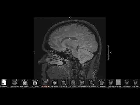 Does MRI show early MS?