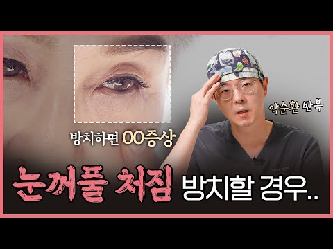 Dark upper eyelids are usually hollow eyes, not pigmentation