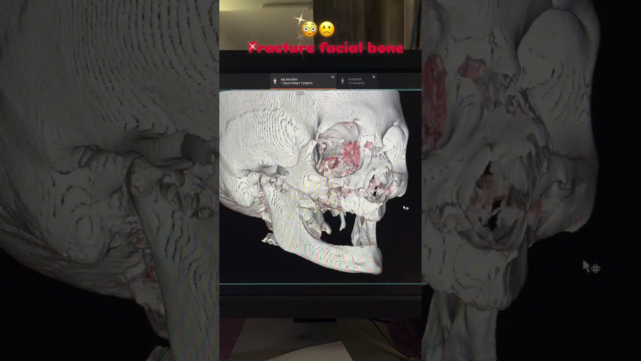 CT Scan Face 3D view 