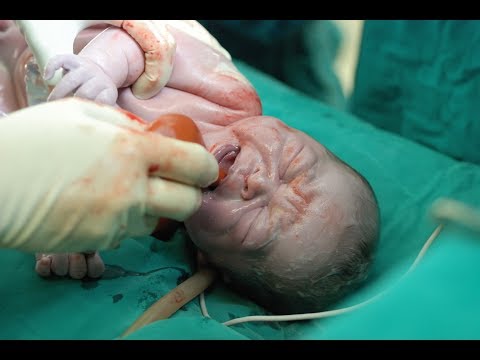 Video: Hypoxia In Newborns - Symptoms, Treatment, Consequences, Signs