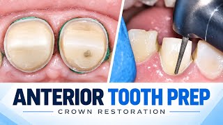 Anterior Tooth Preparation & Crown Restoration | Step-by-Step Clinical Tutorial
