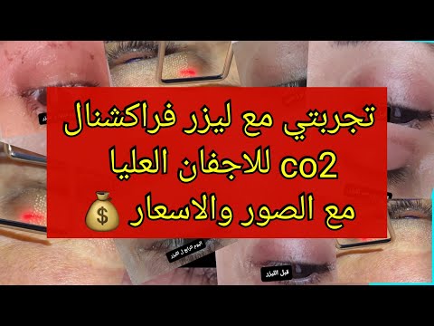 تجربتي مع ليزر فراكشنال 2 للاجفان العليا مع الصور والاسعار