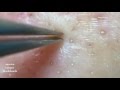 鼻角栓76.2nose blackheads（Larger version）★Tweezers only★