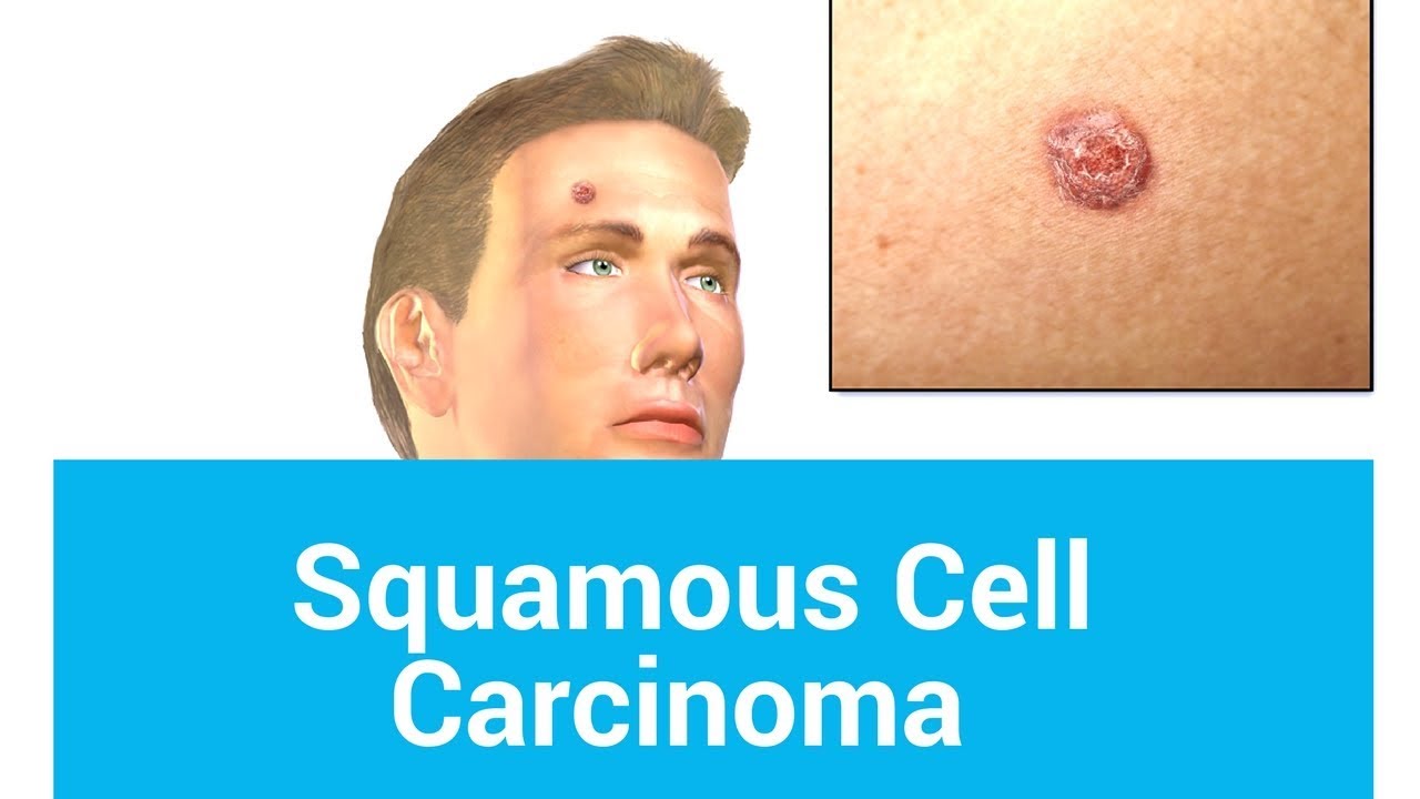 Pictures of Squamous Cell Carcinoma - YouTube