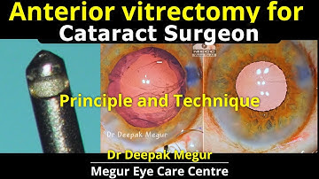 Anterior Vitrectomy Technique for Cataract Surgeons. The Answers all surgeons should know: Dr Megur