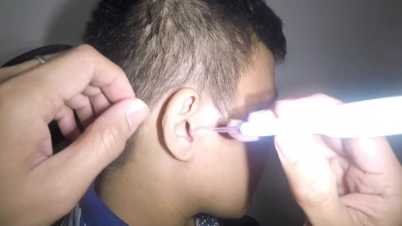 Best Earwax Removal using Ear Curette YouTube