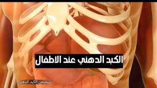 الكبد الدهني عند الاطفال