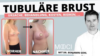 300ml Brustimplantate, passt das zu mir? | Dr. Ben Gehl & Dr. Bartsch