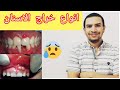 انواع خراج الاسنان و طرق علاجهم