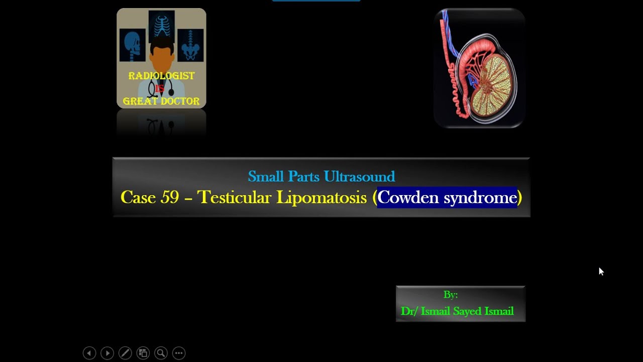 Ultrasound Case 59 - Testicular Lipomatosis (COWDEN syndrome)