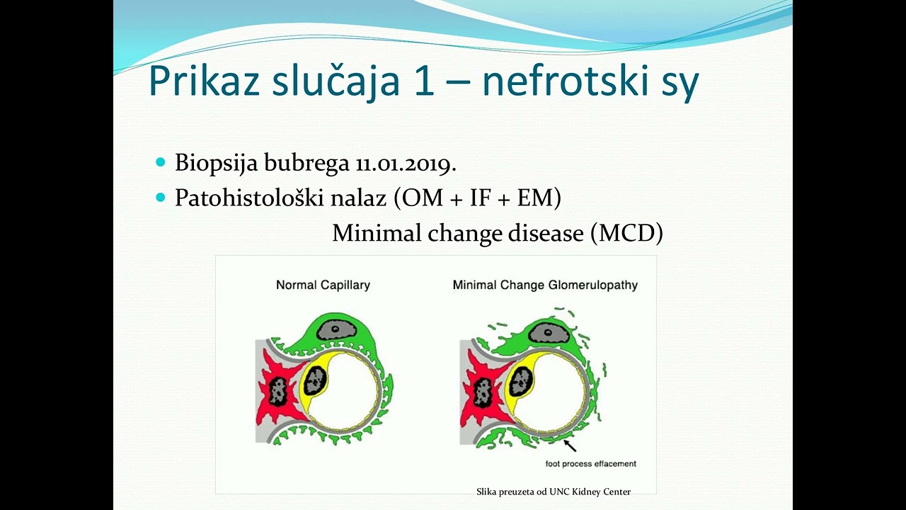 Glomerulske bolesti   dr A Janković   Kl  asistent dr sci med  Aleksandar Janković