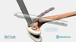 OsTi-Lok on Metaphyseal Fractures