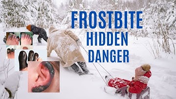 You Must Know What Frostbite Do to Your Body | Frostbite Injury