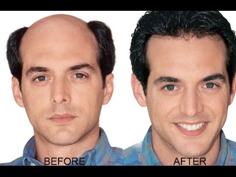 rogaine foam work on receding hairline