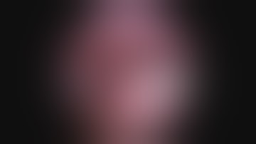 Idimed Intestinal duplication JustRight 5mm Stapler & JustRight Sealer