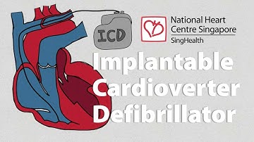 What is an Implantable Cardioverter-Defibrillator (ICD) | What to Expect