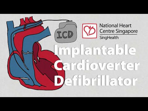 Vídeo: Desfibrilador Cardioverter Implantable (ICD)