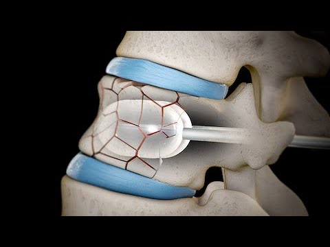 Vertebroplastía y Cifoplastía