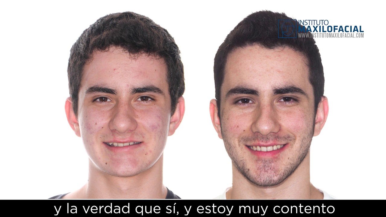 Cirugía ortognática bimaxilar. Caso # 74: Pablo - Clase 2, Biretrusión, sobremordida, cara corta