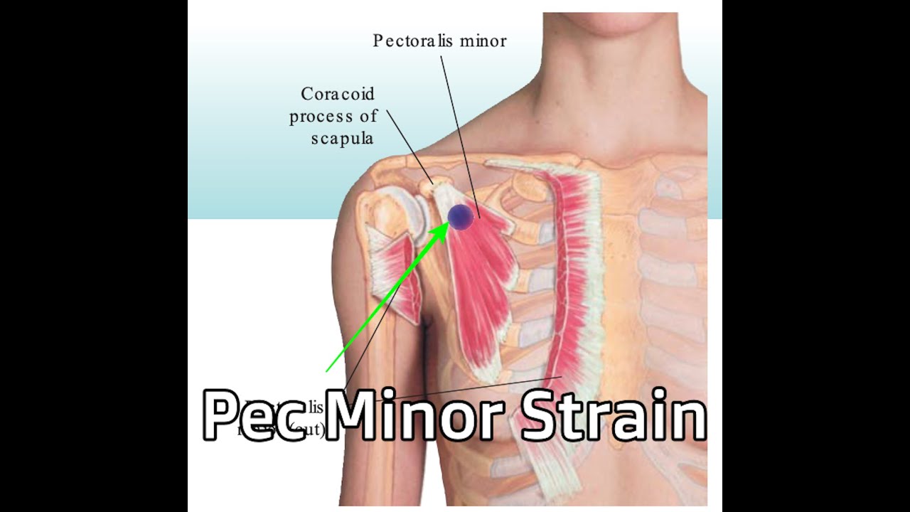 Pectoral Strain - Signs You Are Suffering From It! - By Dr. Akhlaq