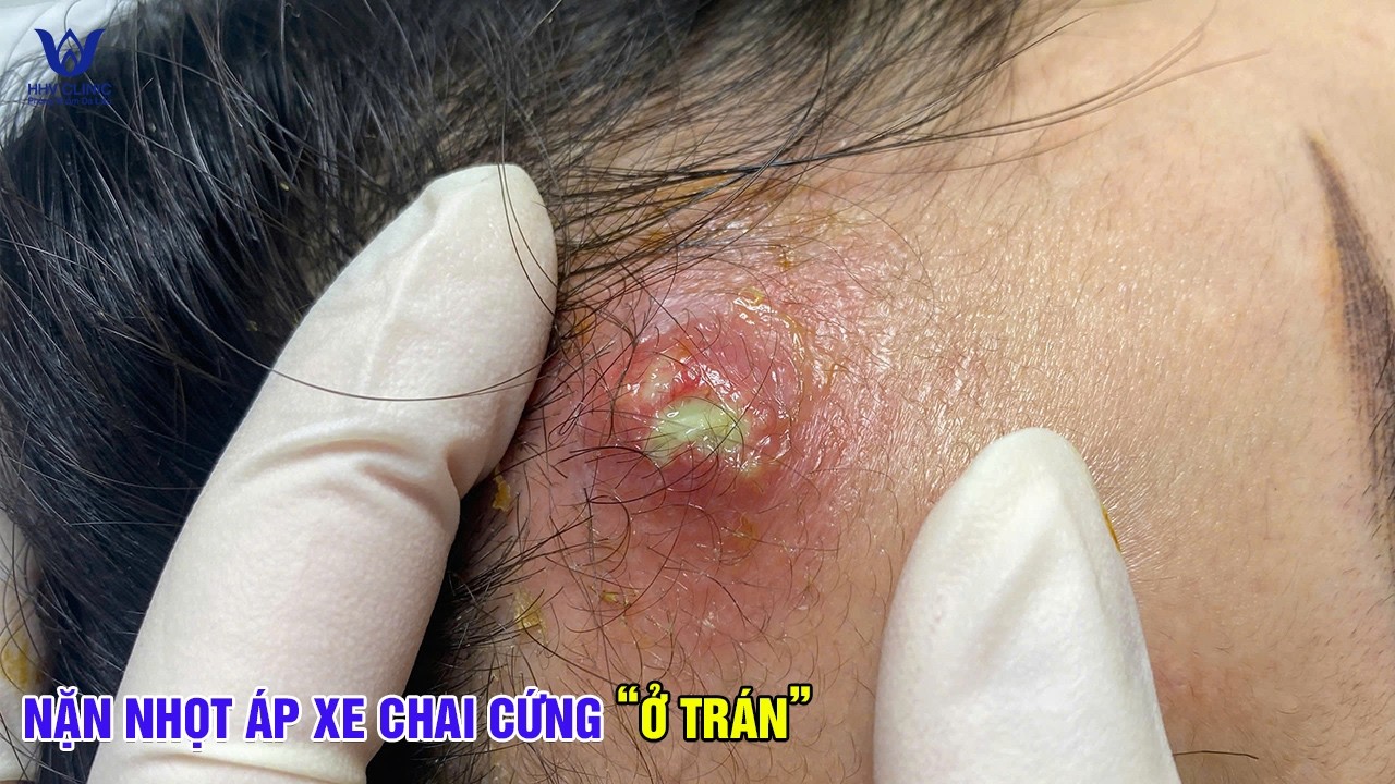 Mụn viêm nặng sát chân tóc dấu hiệu nhiễm trùng sâu
